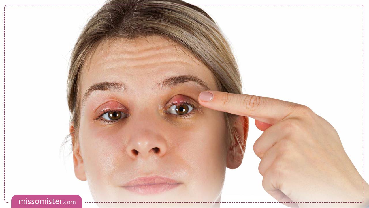سریعترین درمان گل مژه چشم با روش های خانگی