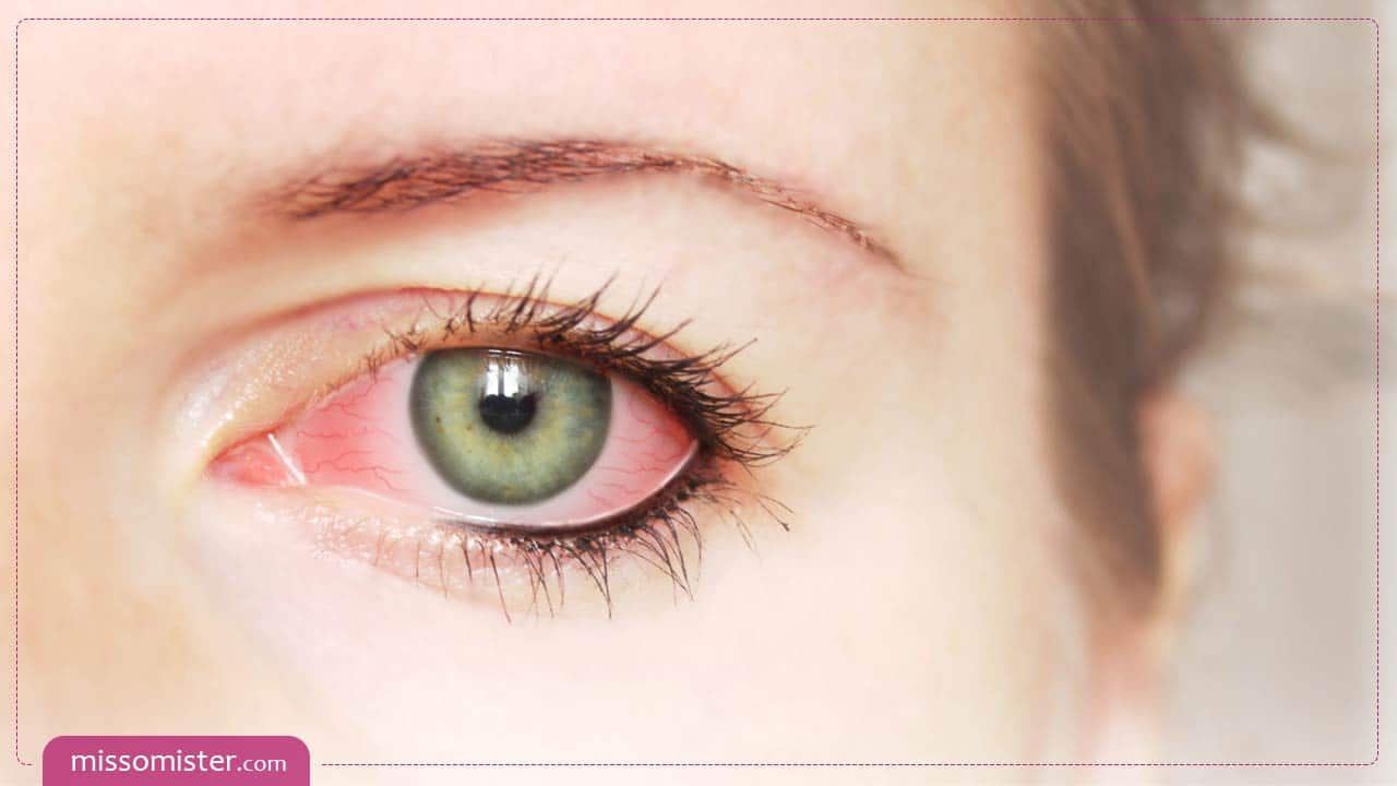 روش های درمان حساسیت چشم به لوازم آرایش کدامند؟