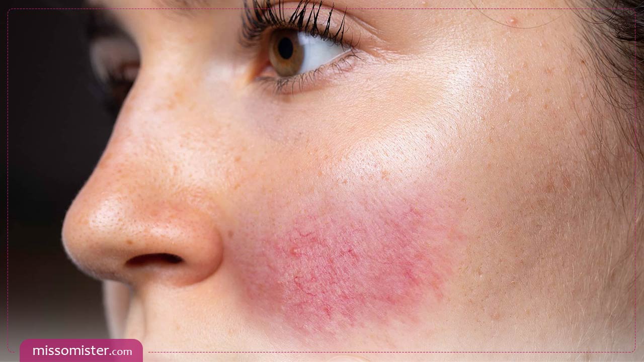 روزاسه چیست و چگونه می توانید این بیماری پوستی را ریشه‌کن کنید؟