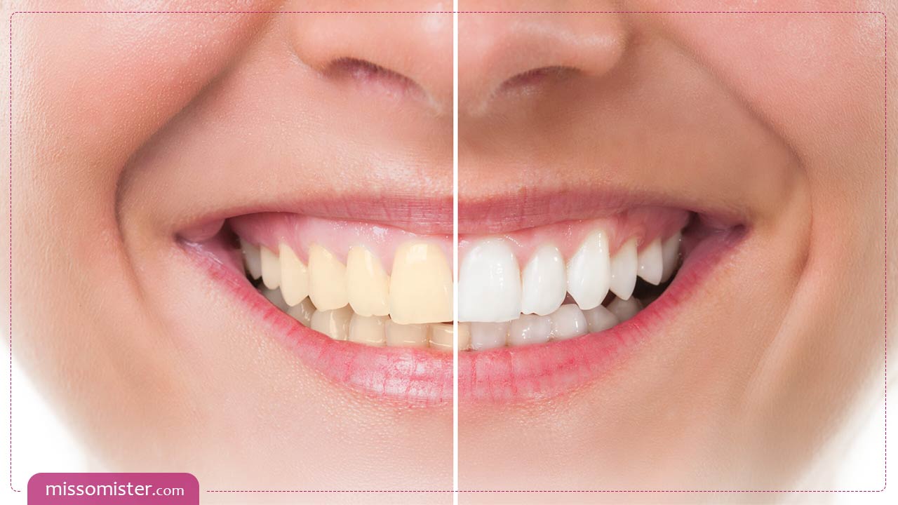 روش های سفید کردن دندان در خانه که واقعا جواب می دهند