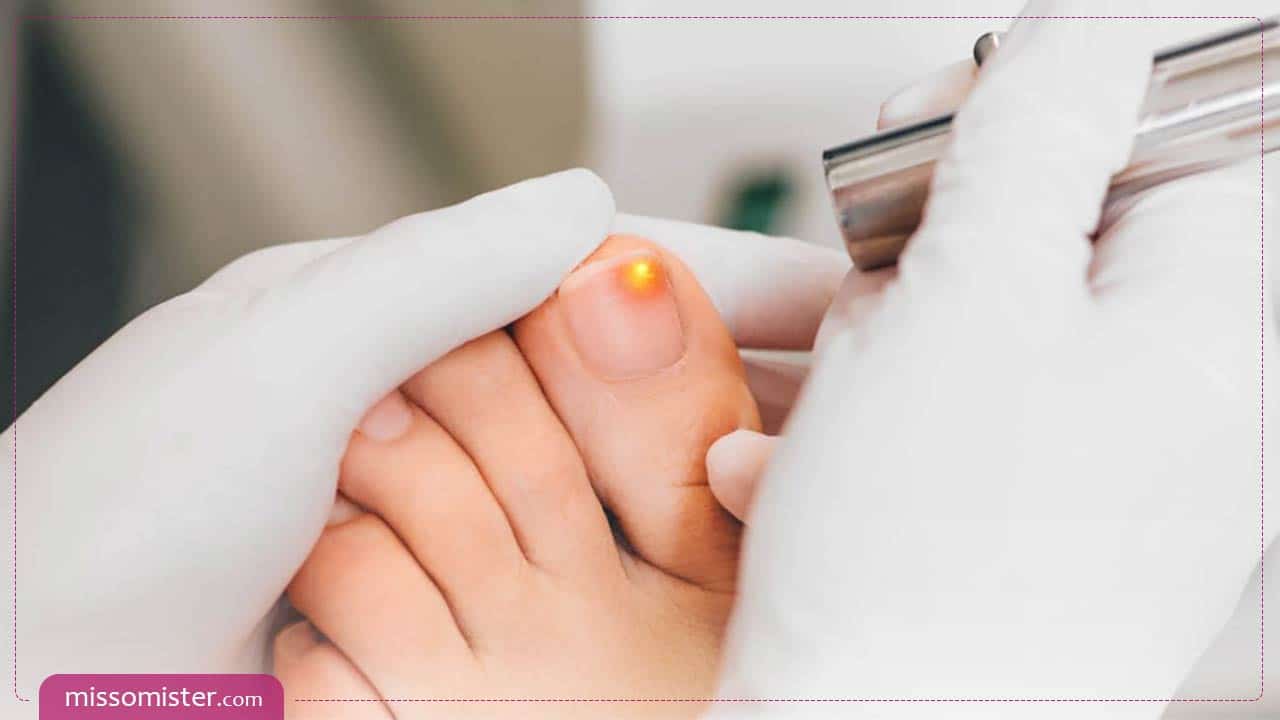 13 روش درمان قارچ ناخن دست و پا در خانه + راهکارهای پزشکی موثر